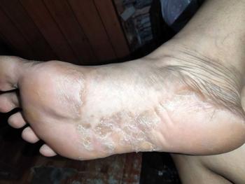 Product Review of JC Callus Remover for Damaged and Cracked Heel With Wooden Foot File Eucalyptus Scented At Home Foot Spa Session Soft  Moisturizer Dry Skin Oil Peeling Nails Moisture Hydrate Hydrating from C**n L**g M** 2
