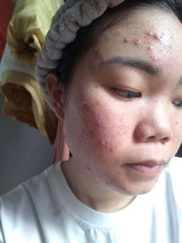 Product Review of [Mã 3] Mua 1 Tặng 1, ACNE SERUM - Serum Diếp Cá 5ml Hỗ Trợ Cải Thiện Mụn - Thương Hiệu: LE'PEAU from T**m N**n 2