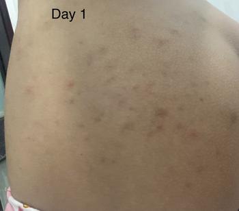 Product Review of Kem chấm mụn Mông mụn Lưng Molazin Skincare from n**₊ 0