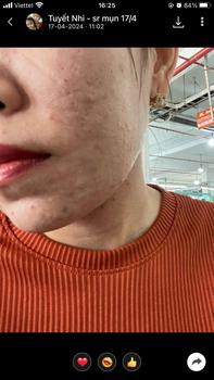 Product Review of [Mã 3] Mua 1 Tặng 1, ACNE SERUM - Serum Diếp Cá 5ml Hỗ Trợ Cải Thiện Mụn - Thương Hiệu: LE'PEAU from ** c**🍒 1