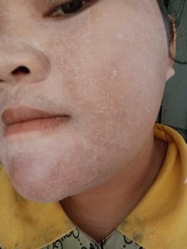 Product Review of Combo kem tái tạo da trị mụn thâm dưỡng trắng da kèm bông gòn (dành cho da khoẻ) from t** 9** 0