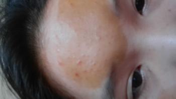 Product Review of [Mã 3] Mua 1 Tặng 1, ACNE SERUM - Serum Diếp Cá 5ml Hỗ Trợ Cải Thiện Mụn - Thương Hiệu: LE'PEAU from e**t s**n ** 0