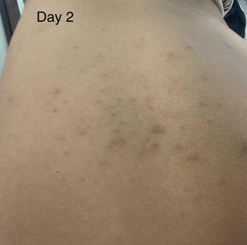 Product Review of Kem chấm mụn Mông mụn Lưng Molazin Skincare from n**₊ 1