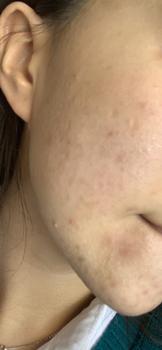 Product Review of [Mã 3] Mua 1 Tặng 1, ACNE SERUM - Serum Diếp Cá 5ml Hỗ Trợ Cải Thiện Mụn - Thương Hiệu: LE'PEAU from n**h 2