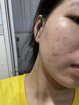 Product Review of [Mã 3] Mua 1 Tặng 1, ACNE SERUM - Serum Diếp Cá 5ml Hỗ Trợ Cải Thiện Mụn - Thương Hiệu: LE'PEAU from M** h**g v** 3
