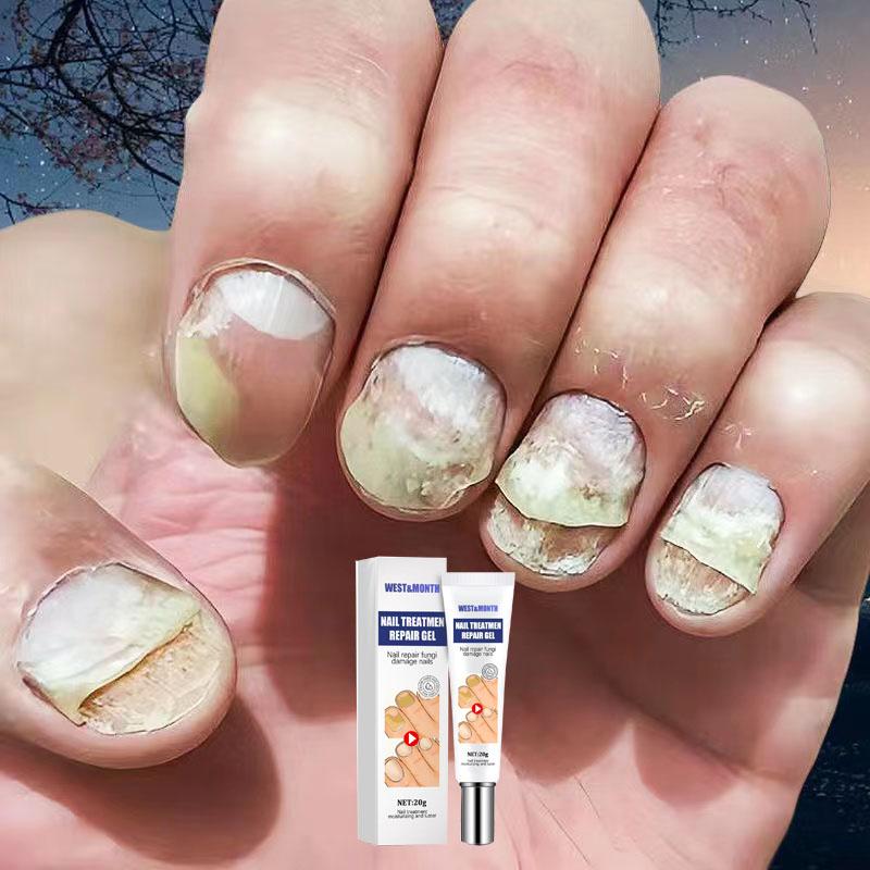 【SALE Kem đánh bay nấm móng, hư khoé, bọng móng, nước ăn tay chân gia truyền