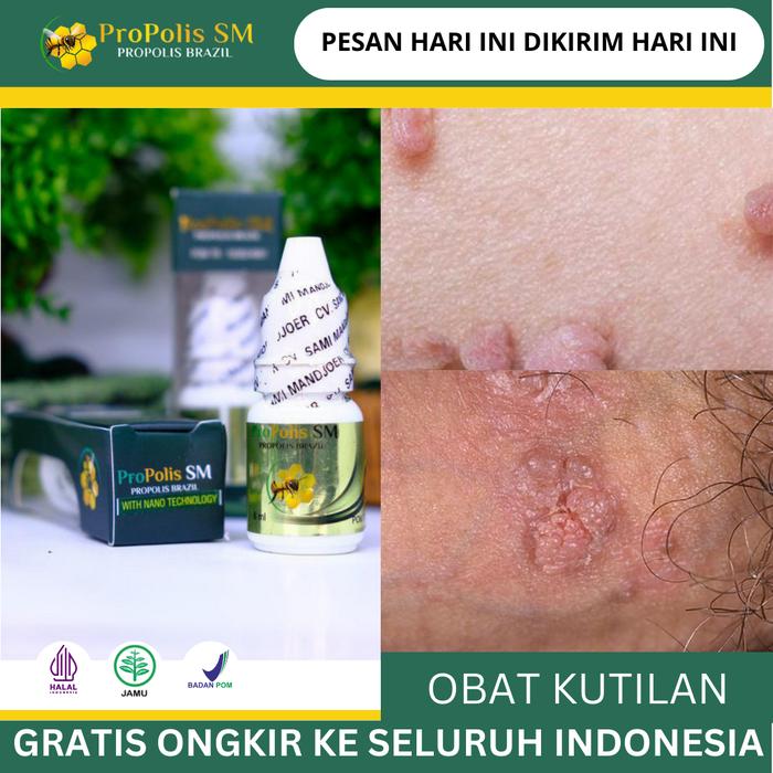 Gambar PROPOLIS SM 100% Original Perontok Kutil Dileher, Kutil Papiloma, Perontok Skin Tag, Kutil Di Wajah, Perontok Kutil Kelamin, Kutil Kelamin HPV, Kutil Kelamin Pria, Kutil Kelamin Wanita, Benjolan Kecil Pada Kemaluan dari irvan herbal store Kota Administrasi Jakarta Barat Tokopedia