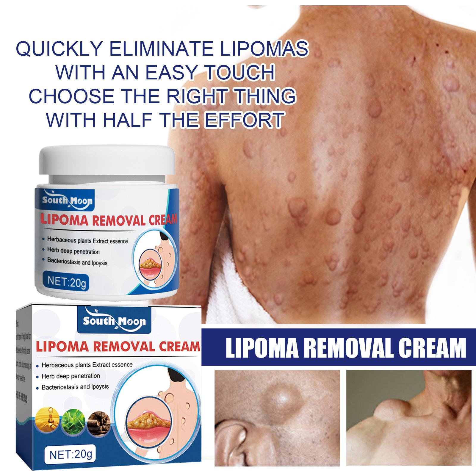 Salep Lipoma [IMPORT ASLI] Krim Lipoma Benjolan di Tubuh Penghancur Benjolan Kelenjar Getah Bening