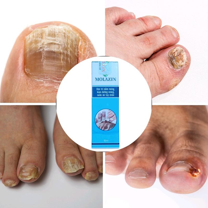 Nấm Móng Tay Chân,  Loạn Dưỡng Móng, Thối Móng Tay Chân Dứt Đỉm 1