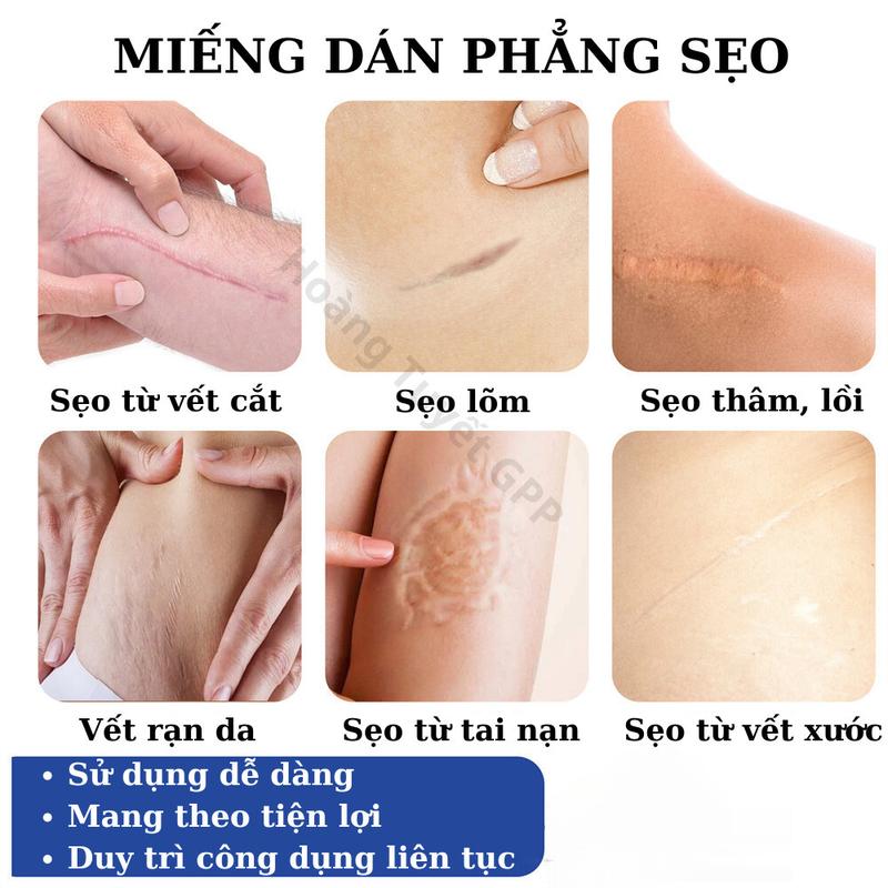 Product Introduction of Miếng dán sẹo silicone phẳng sẹo lồi, sẹo sau sinh, sẹo nâng ngực, sẹo bỏng ScarPass sạch sẹo, sáng da, ngừa thâm 5