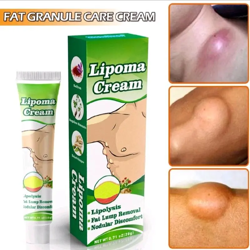 Lipoma Cream 20 gram Obat Lipoma untuk Benjolan di Leher, Tangan, Ketiak, Punggung, Pundak, Kaki, Selangkangan, dan Telinga - Tubuh, Hand 1