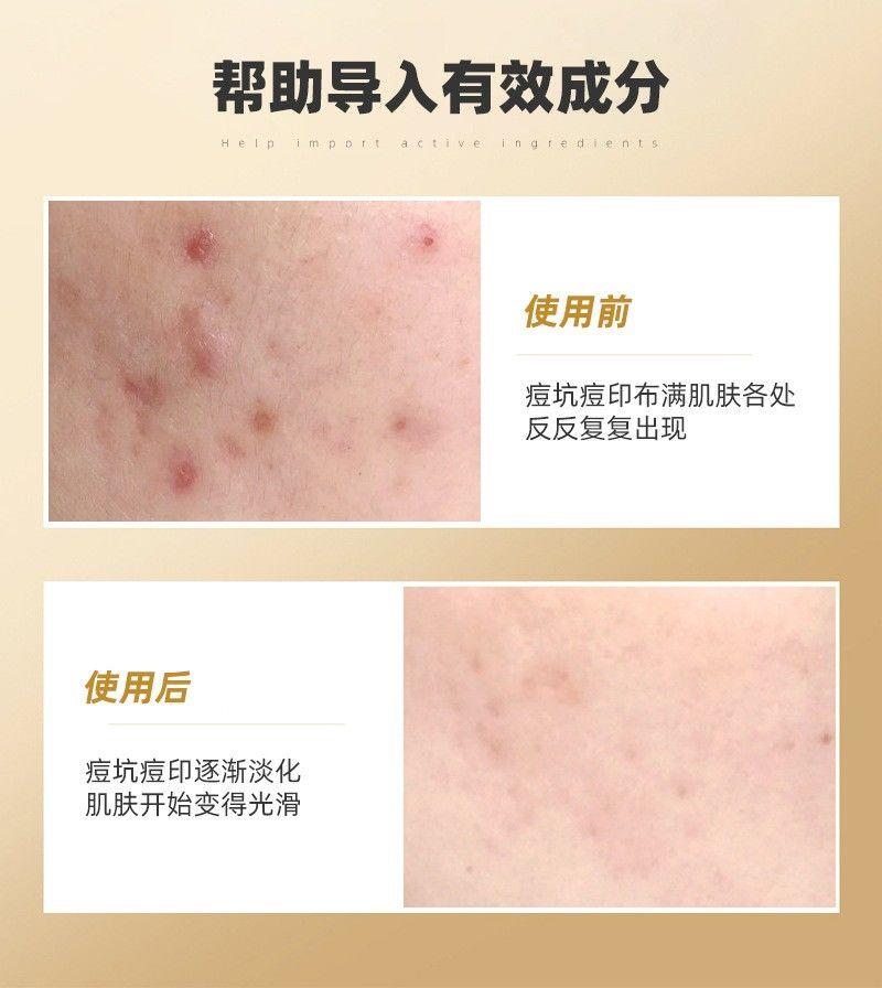 Product Introduction of Con Lăn Kim Y Tế, Con Lăn Kim Nhập Khẩu, Con Lăn Đầu Con Lăn Kim Siêu Nhỏ Thích Hợp Cho Thẩm Mỹ Viện Và Sử Dụng Cá Nhân, Để Tóc Mọc, Mặt Và Cơ Thể, 2024 2