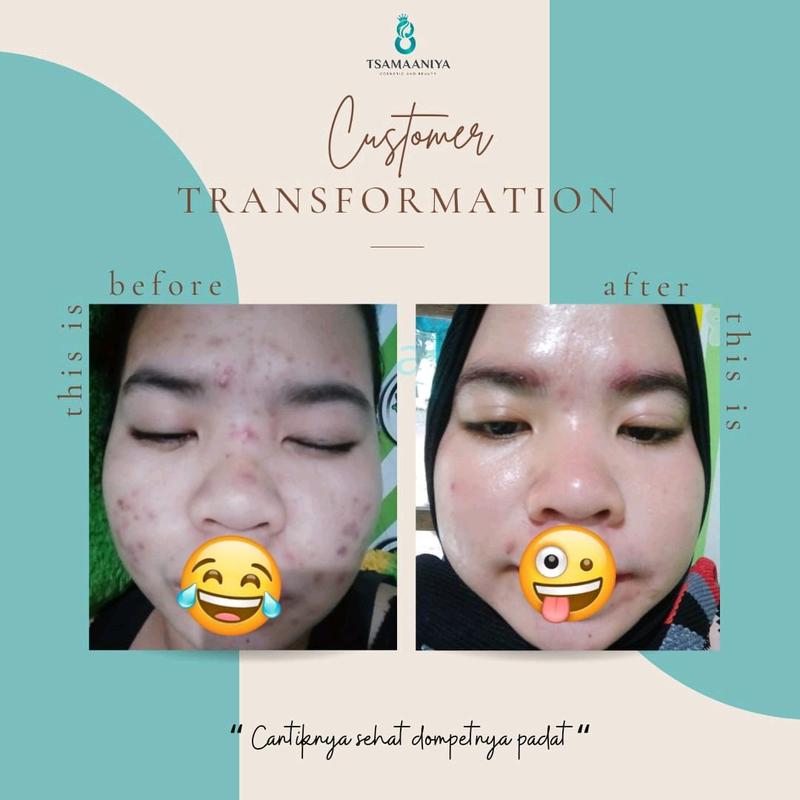 Tsamaaniya paket acne basic (untuk jerawat aktif) 2