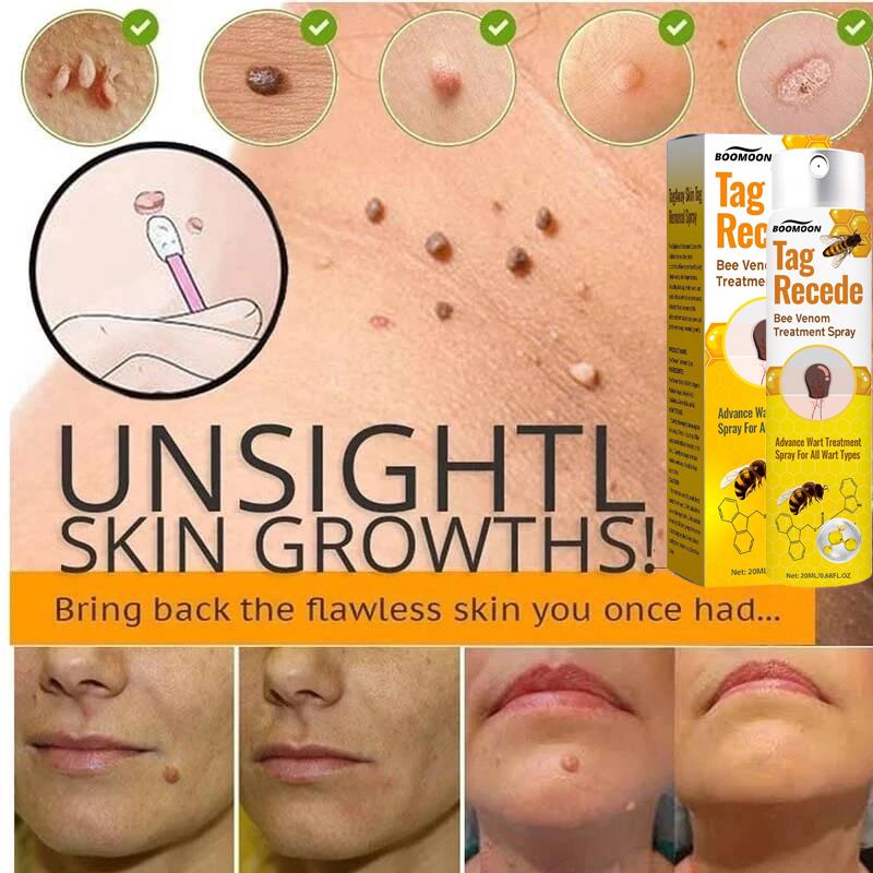 Penghilang Kutil Dan Tahi Lalat Obat Penghilang Kutil Penghilang Tahi Lalat Di Wajah Obat Kutil Ampuh Skin Tag Remover [S09]