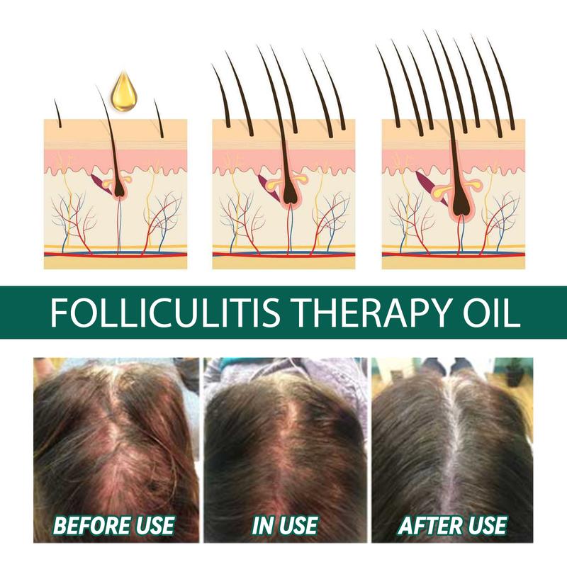 Product Introduction of EELHOE Essential Oil For Scalp, And Hair Scalp Deep Cleaning And Repair Hair Root Anti-Itching And Anti-Loss Hair Solid Care Essential Oil 5