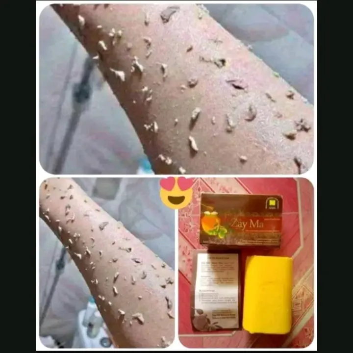 Termurah Sabun Perontok Daki Paling Ampuh Aman Ber Bpom Daki