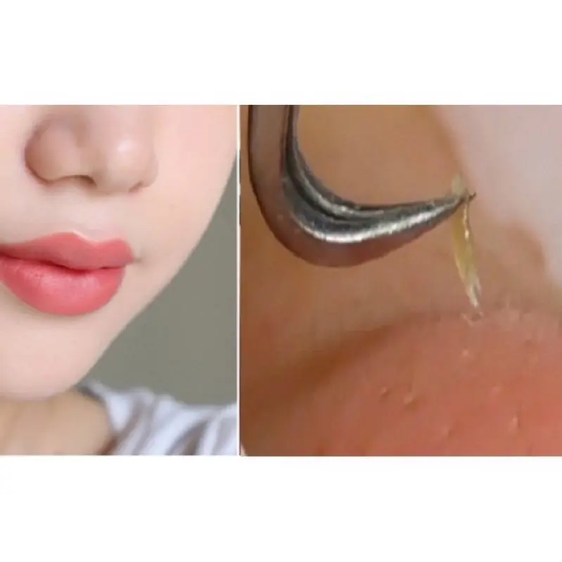 Bộ 3 Cây gắp nặn mụn đầu đen, mụn trứng cá thép không gỉ dài 8cm 2