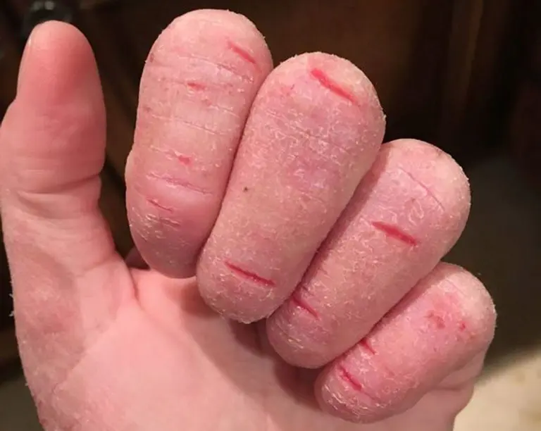 <Xanh lá> Kem bôi nứt lẻ chân tay, á sừng, côn trùng đốt - Cực hiệu quả 2