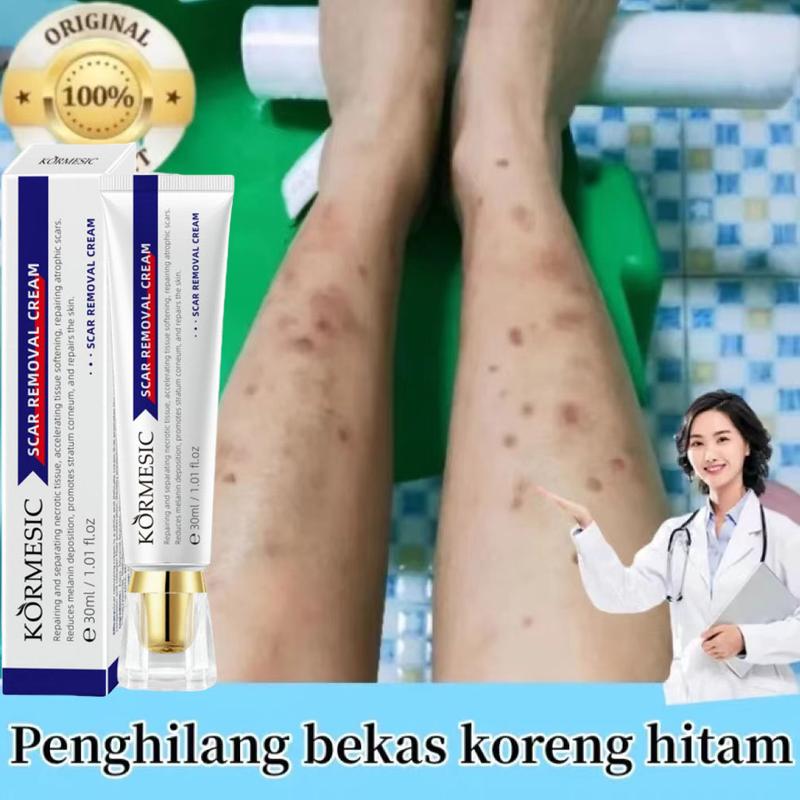 Kem khử thâm, xóa sẹo cũ, loại sẹo ở chân, sẹo côn trùng cắn, sẹo lồi, sẹo bỏng