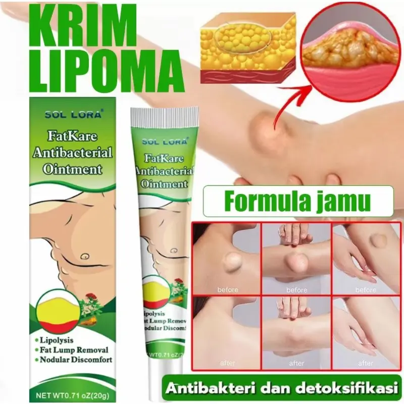 SOL LORA lipoma cream salep benjolan 100% Original Herbal Ampuh lipoma cream salep benjolan 7 days lipoma removal cream 1