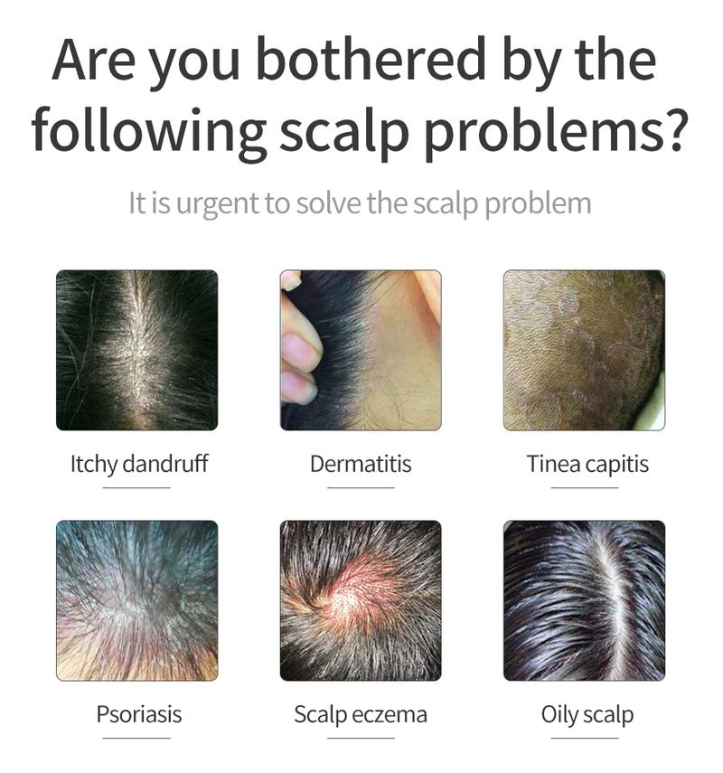 Product Introduction of Antipruritic Hair Shampoo Treat Psoriatic Seborrheic Dermatitis Anti Dandruff Oil Control Damage Repair 7