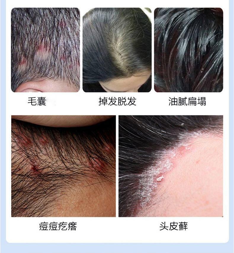Product Introduction of Xikangwang Anti-Dandruf and Relieve Itching Washing Water Oil Removing Refreshing Skin Washing Cream Anti-Mite Grease-Overflow Moss Lotion 4