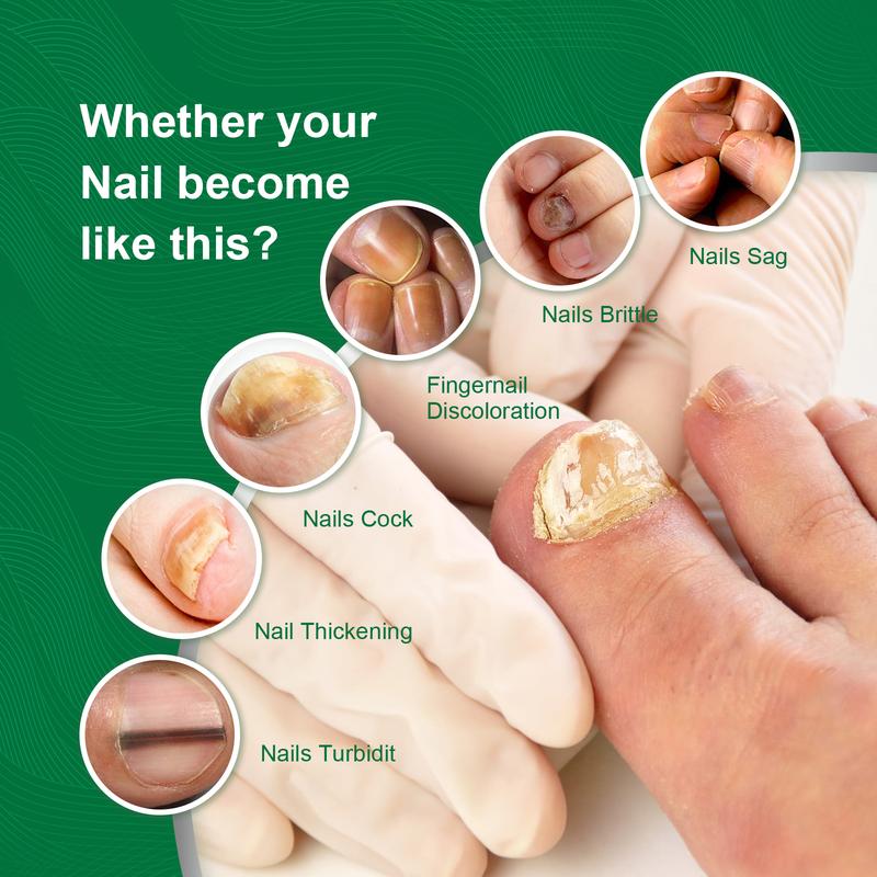 Product Introduction of 100% Original Brand Ouhoe Toenail Repair Essence Gray Nail Soft Yellow Thickening Inlay Bright Manicure Comfort 5