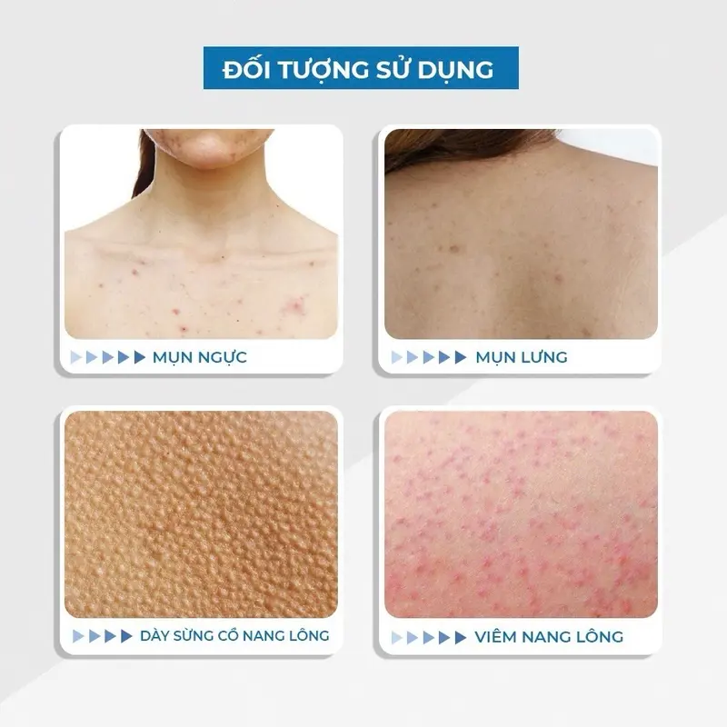 [Mẫu mới] Combo xịt mụn sữa tắm Freeskin Forte, dùng cho mụn cơ thể, viêm nang lông, viêm da 7