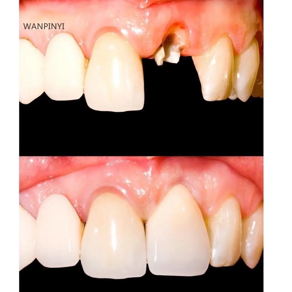 Kit Gigi Palsu Murah Flase Teeth DIY Smile - 30 Batang Gigi 3 Jenis Warna - Nasal, Putih