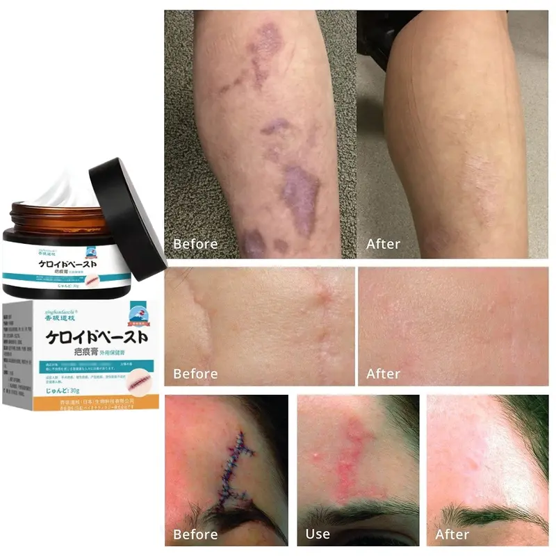 Salep Penghilang Bekas Luka Susu Tubuh Penghilang Bekas Luka Koreng Hitam Penghilang Bekas Luka Gigitan Nyamuk, Stretch Mark, Penghilang Bekas Luka Jahitan 3