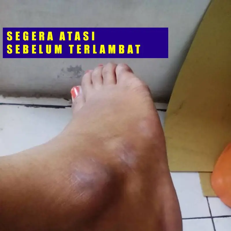 Perawatan Mata Kaki Hitam Ampuh 2