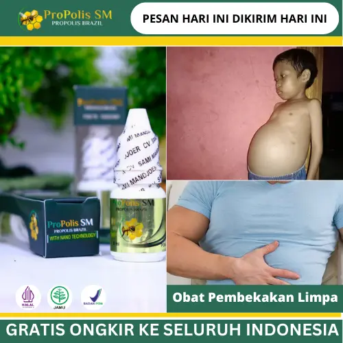 Penghilang Pembengkakan Limpa, Limpa Bengkak, Liver Perut Bengkak, Perlemakan Hati, Infeksi Bakteri, sakit perut sebelah kiri, Herbal Pembengkakan Limpa Dengan Propolis Sm