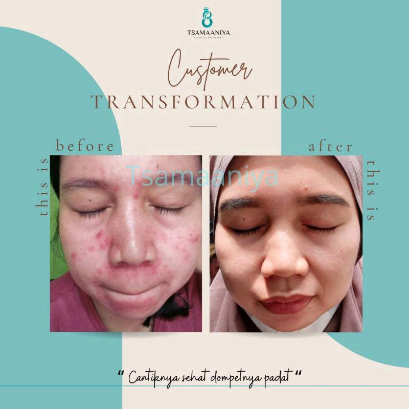 Tsamaaniya paket acne basic (untuk jerawat aktif) 5