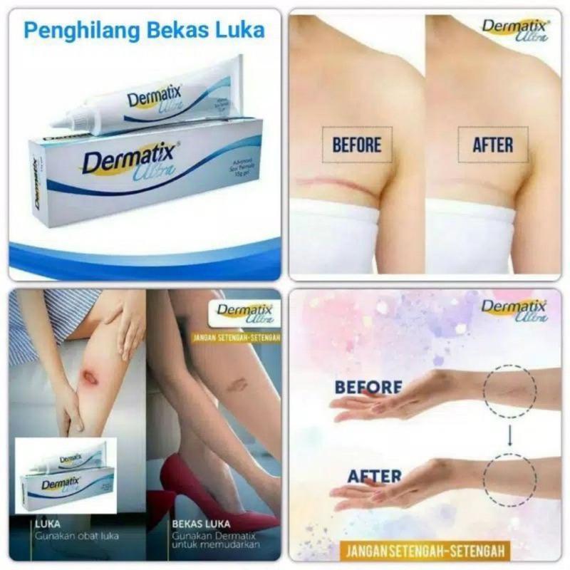 Product Introduction of COD Dermatix dermatix penghilang bekas luka  Apotik  15gel Krim Penghilang Bekas Luka Origina 5