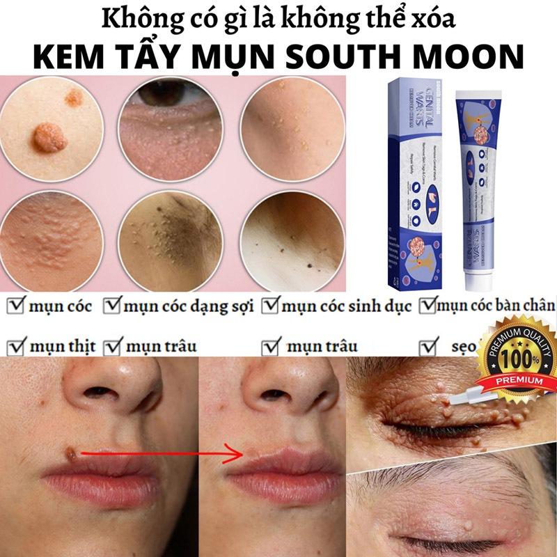 kem xoá mụn cóc,mụn thịt,loại bỏ mụn cóc thông thường,mụn đá,mụn cơm,mụn cóc dạng sợi 20g 5