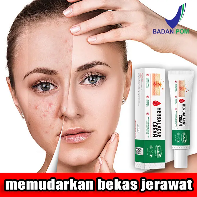 CINSULIN HERBAL ACNE CREAM 30g Menghilangkan Jerawat Memperbaiki Kulit Dengan Cepat Menghilangkan Jerawat Pria dan Wanita Penghilang jerawat   jerawat dan bekas jerawat penghilang bekas jerawat Lembut tak menyebabkan iritasi