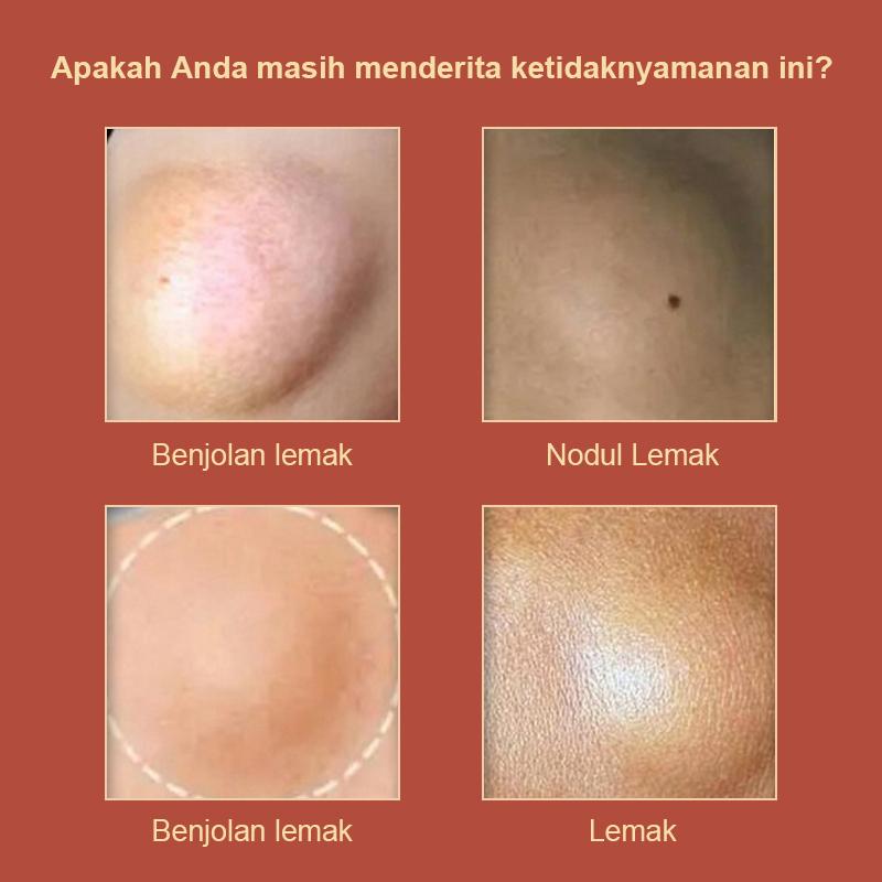 Salep Lipoma [IMPORT ASLI] Krim Lipoma Benjolan di Tubuh Penghancur Benjolan Kelenjar Getah Bening