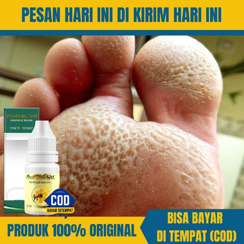Cairan Penghalus Kaki Rayapan Telapak Kaki Bolong Berlubang Propolis SM Hand Tangan Perawatan Lotion 9