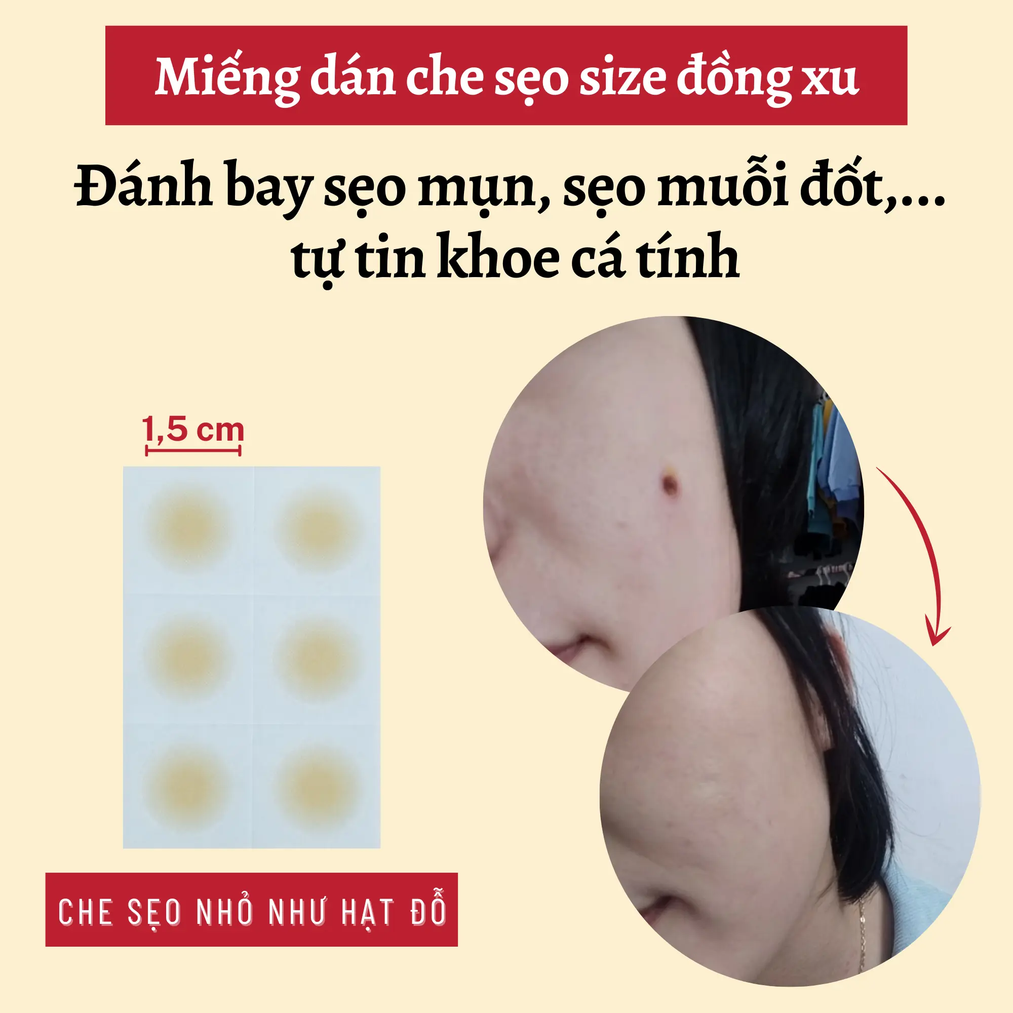 Miếng dán che sẹo mụn, che sẹo muỗi đốt đường kính 1,5cm siêu mỏng chống nước