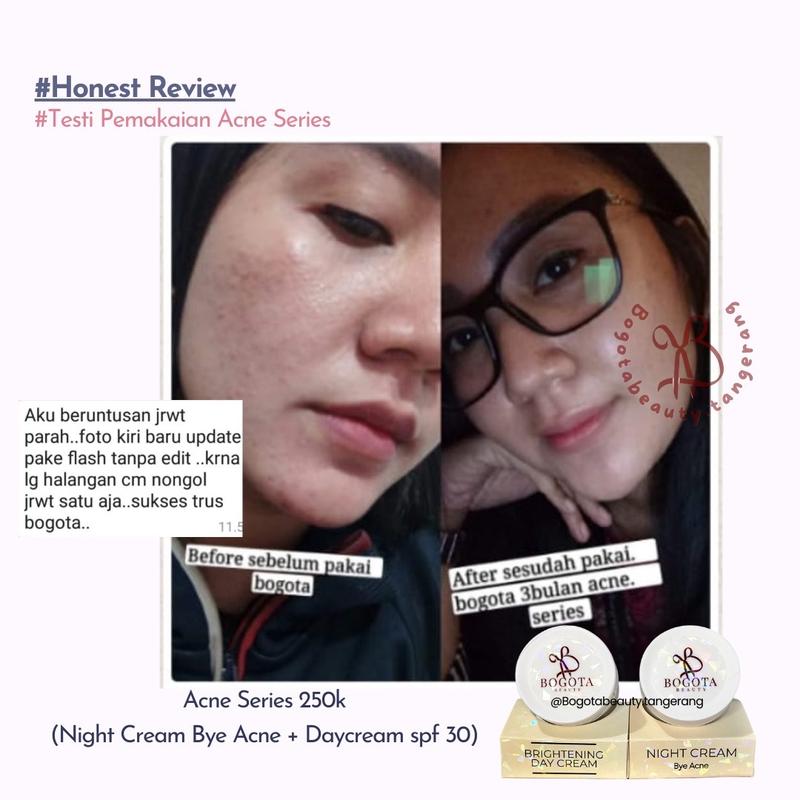Bogota Beauty Skincare Bogota Normal Series Bogota Acne Series by Bogota Beauty Semua Jenis Kulit 4