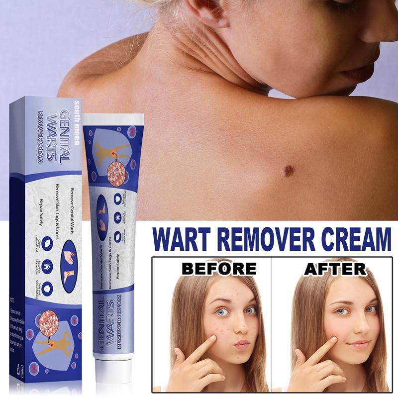 kem xoá mụn cóc,mụn thịt,loại bỏ mụn cóc thông thường,mụn đá,mụn cơm,mụn cóc dạng sợi 20g 1