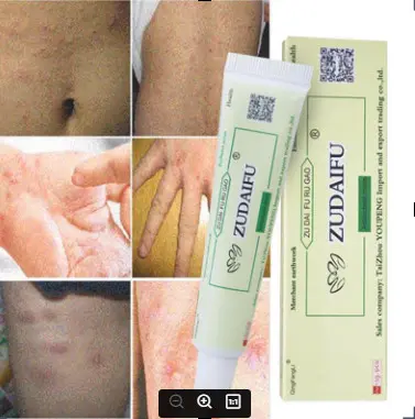 Kem giảm thâm ghẻ ngứa viêm da côn trùng đốt nước ăn chân tay