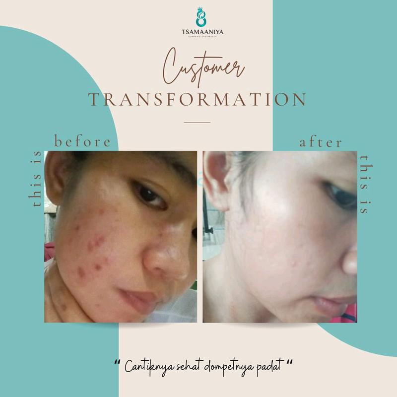 Tsamaaniya paket acne basic (untuk jerawat aktif) 4