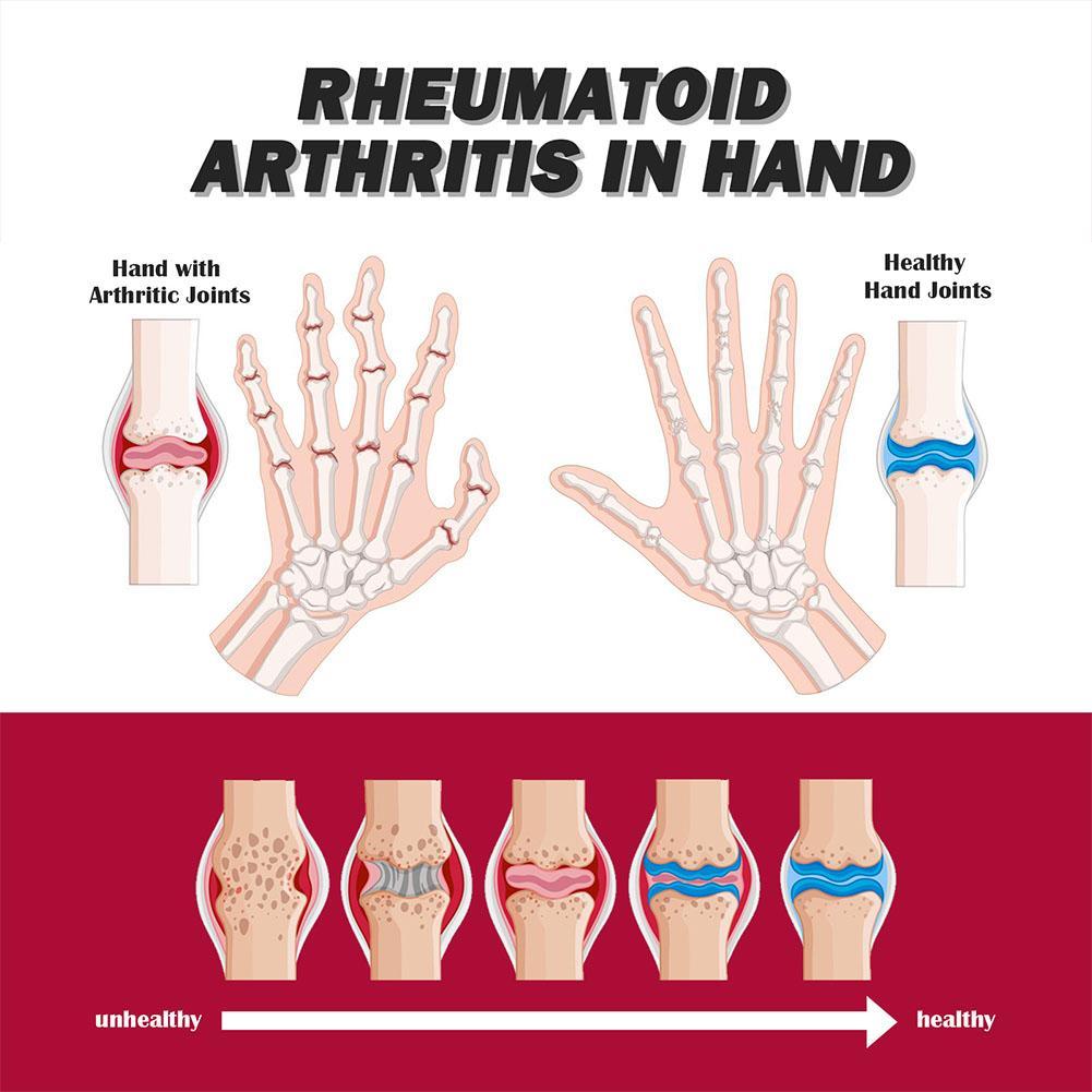 South Moon Joint Bone Therapy Intensive Concentrate Dan Pengobatan Terapi Sendi Krim Pereda Y9R3