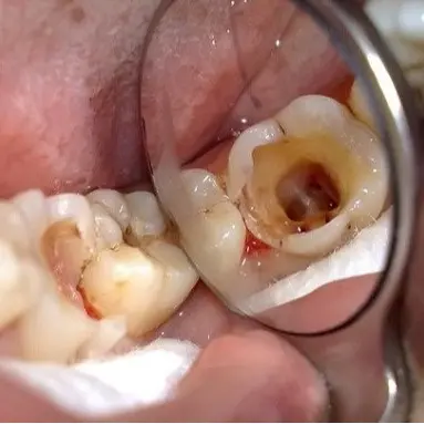 SÂU RĂNG hãy làm theo 4 bước này với tinh dầu răng miệng DẠ THẢO LIÊN
