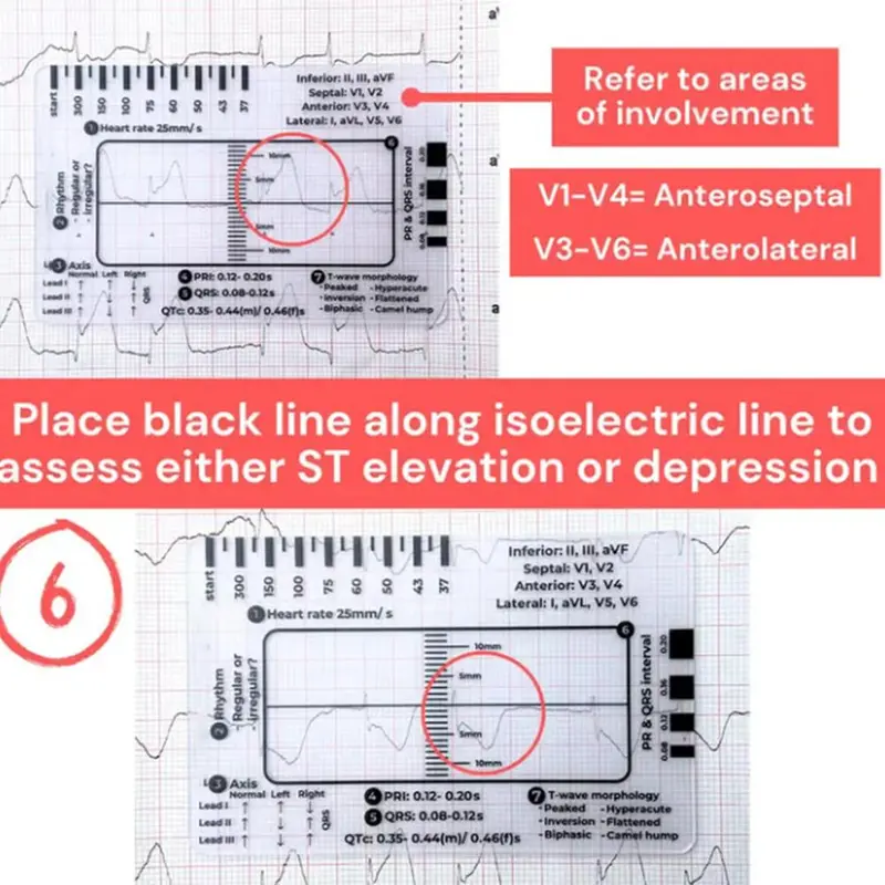 Thước 7 Bước, Cầm Tay, Hướng Dẫn Tham Khảo Bỏ Túi Giải Thích Ecg, Trong Suốt, Thiết Kế Nhỏ Gọn, Dụng Cụ Đánh Giá, Để Đo Lường 6