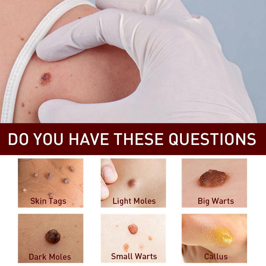 Penghilang Kutil Dan Tahi Lalat Obat Penghilang Kutil Penghilang Tahi Lalat Di Wajah Obat Kutil Ampuh Skin Tag Remover [S09]