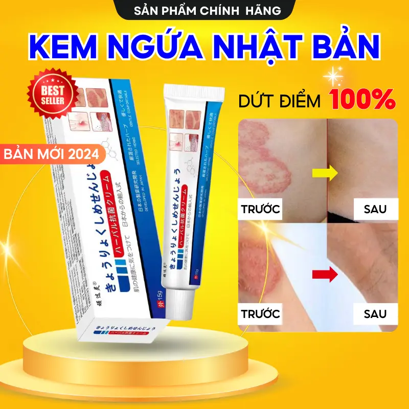 Japanese Atopic Dermatitis Cream Completely Supports Psoriasis, Tinea Capitis, Eczema, Keratosis with Extreme Effectiveness