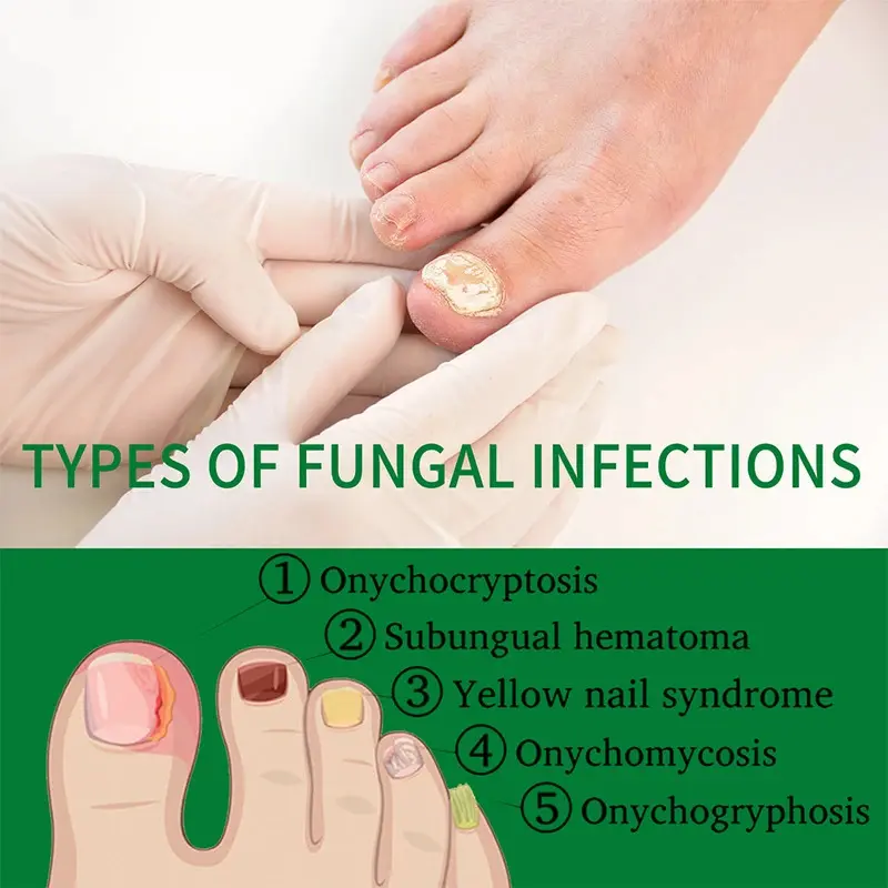 EELHOW Nail Repair Gel Strengthen Brighten Toenails Foot Nail Care Treatment Ginger Kutek 5