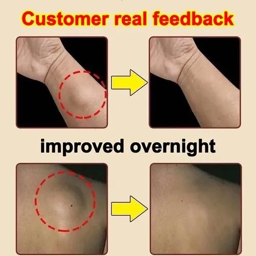 Salep Lipoma [IMPORT ASLI] Krim Lipoma Benjolan di Tubuh Penghancur Benjolan Kelenjar Getah Bening